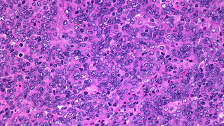What happens if I am overexposed to formaldehyde?