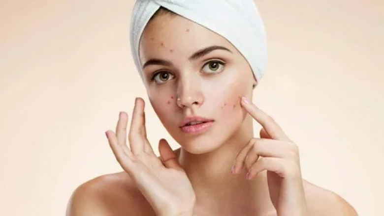 Global Acne Vulgaris Treatment Market: Industry Trends, Share, Size, Growth, Opportunity and Forecast 2022-2028