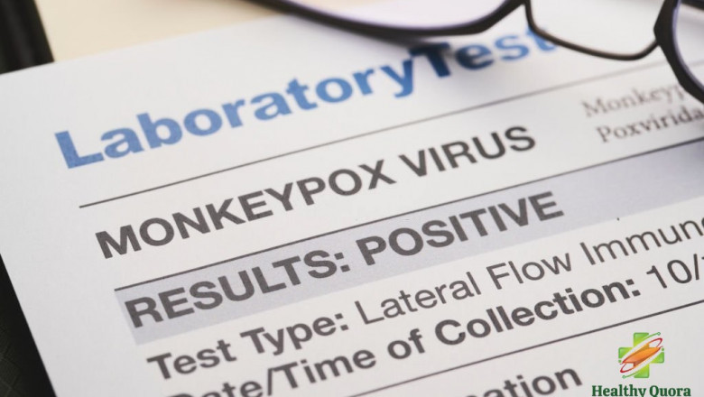 How do you cure monkeypox? Get answer on HealthyQuora