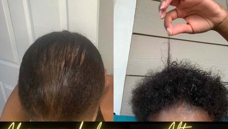 4 Hair Loss Myths It’s Time to Forget