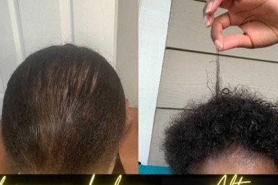 4 Hair Loss Myths It’s Time to Forget