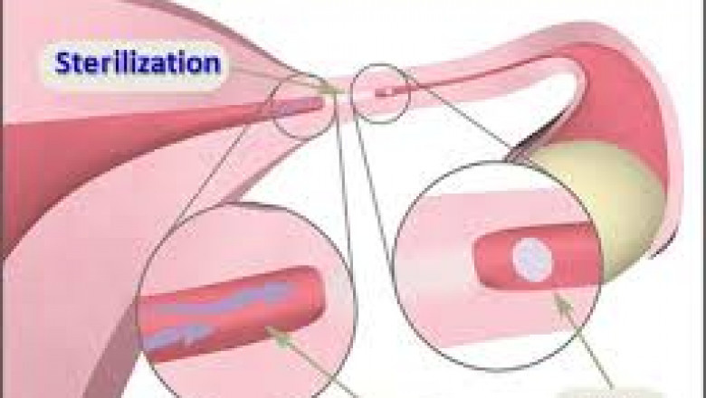 Female Sterilization Procedures Market Size, Share, Regional Overview and Global Forecast to 2028