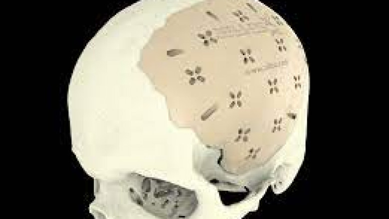 Global Cranial Implants Treatment Market 2022: COVID-19 Impact Analysis and Industry Forecast Report, 2028