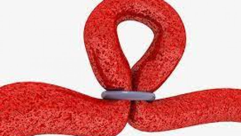 Tubal Ligation Market Size, Status, Growth | Industry Analysis Report 2020-2028