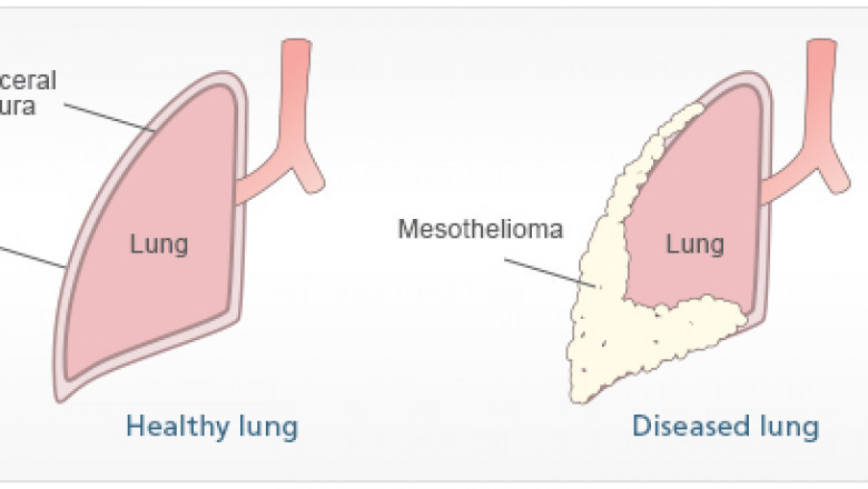 8 Important Facts to Know if You’re Diagnosed with Mesothelioma Cancer