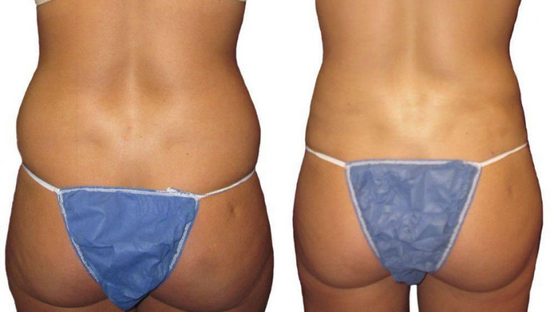 Why Go For The Brazilian Butt Lift Procedure?