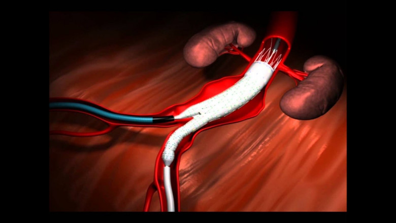 Global Abdominal Aortic Aneurysm Repair Devices Market Regional Analysis