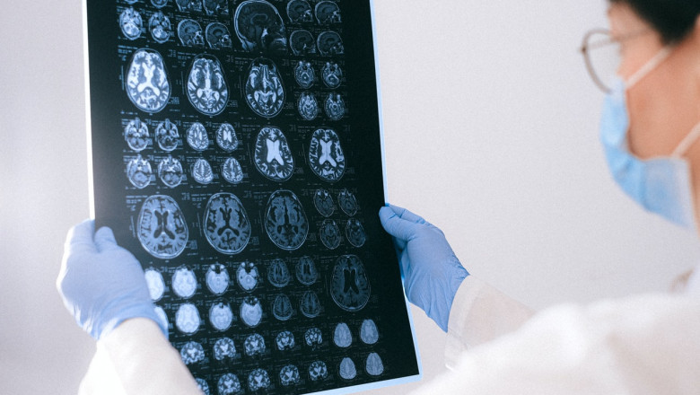 3 Common Symptoms of a Traumatic Brain Injury Texas