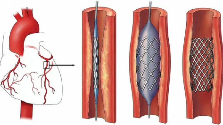 Blockages in vascular pathways can be treated with stents.