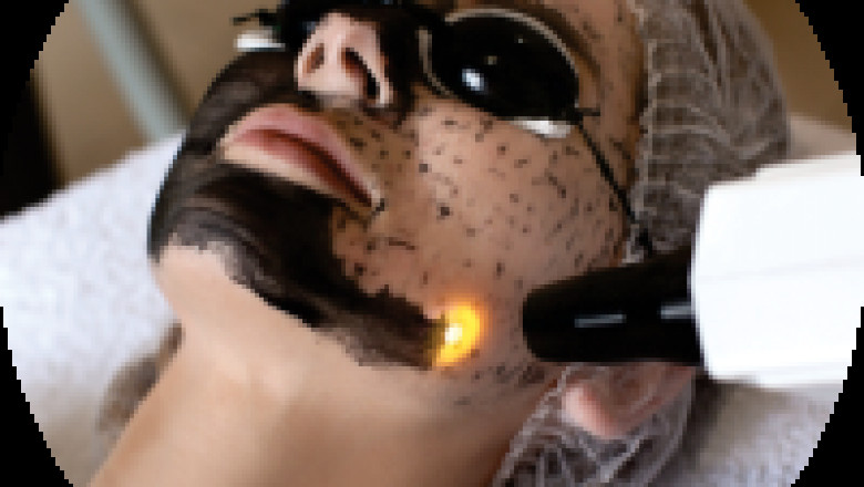 Laser Blackout Peel Facial | Laser Skin Rejuvenation