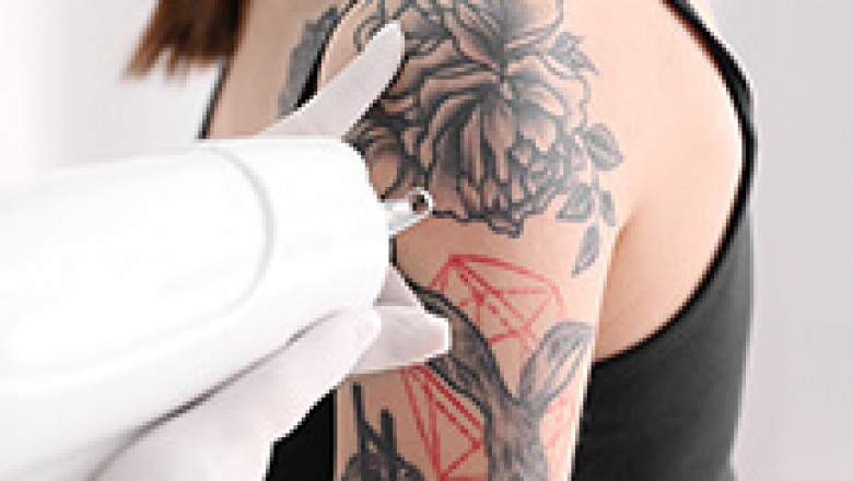 Laser Tattoo Removal | Musk