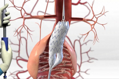 A minimally invasive procedure called Endovascular Aneurysm Repair (EVAR) can be used to treat abdominal aortic aneurysms.