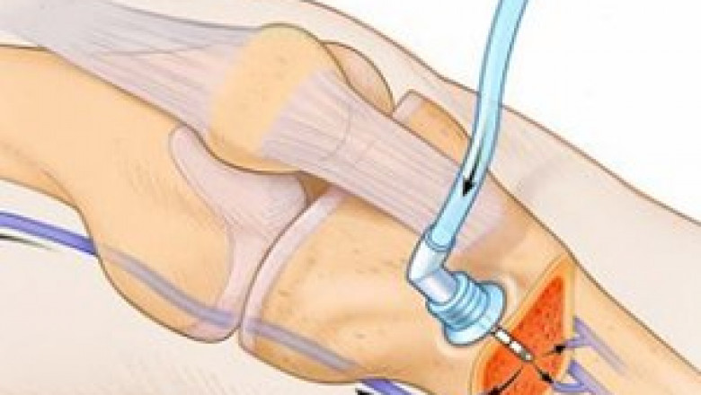 Intraosseous Device Market Trends, Research, and Analysis for the Forecast Period 2022-2030