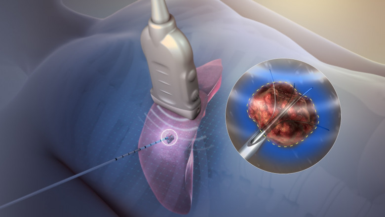 Radio Frequency Ablation Device Convert Electromagnetic Energy into Heat Energy by Utilizing High-Frequency Alternating Currents