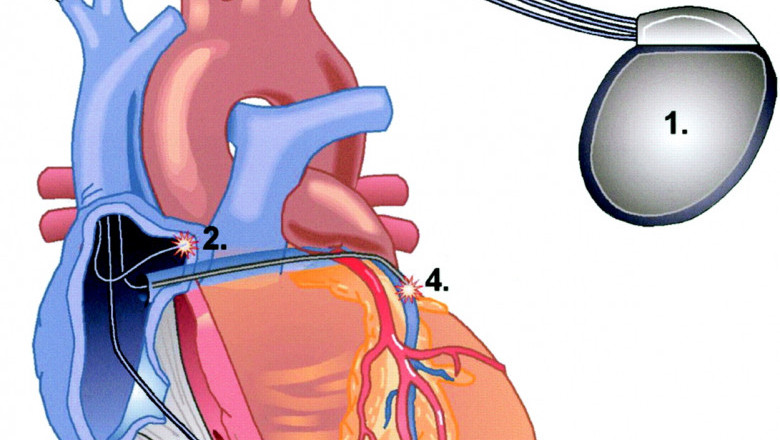 Cardiac Resynchronization Therapy Devices Market 2022 Size, Dynamics & Forecast Report to 2028