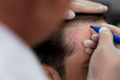 What to avoid after a hair transplant for the best result
