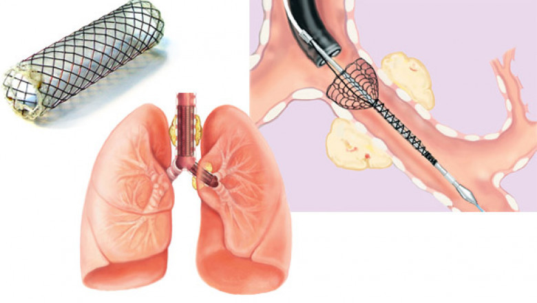 Airway stent and lung stent Market [Top 10 Vendors] Share, Size Analysis | Global Report 2029