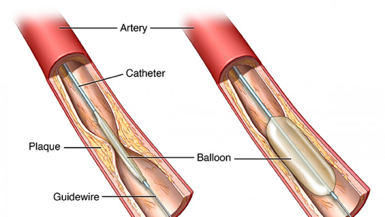 Angioplasty: What Is It, Experience, Risks, And Recovery?