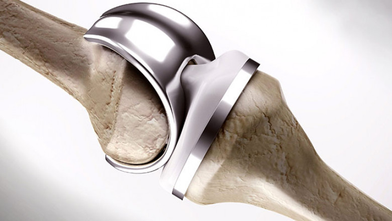 When Bone Grafting is Not Practicable, Bone Replacement Products are Commonly Employed