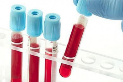 Blood Screening Market 2022 | Covid-19 Impact Analysis and Industry Forecast Report Till 2028
