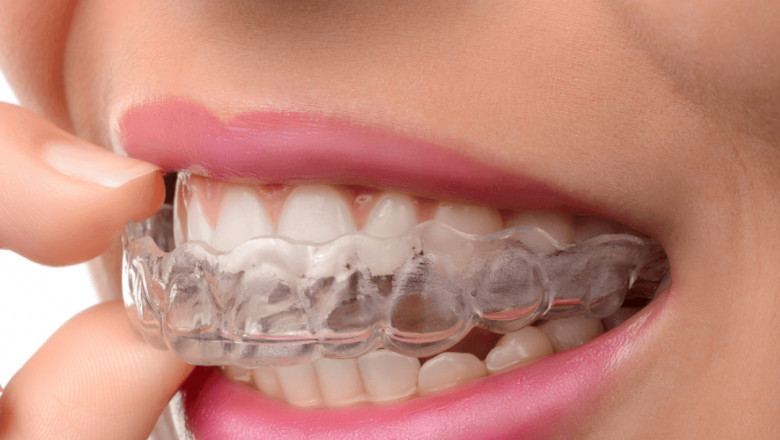 What Are Dental Veneers?