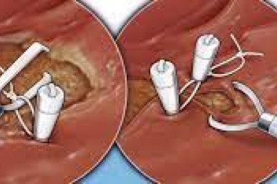 Endoscopic Clip Market Size, Key Players Analysis And Forecast To 2028 | Value Market Research