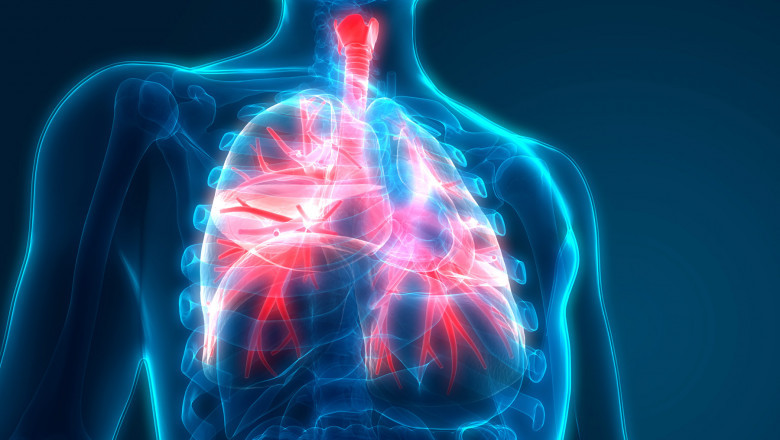 Chest Infection Medicine - Herbal Medicine For Chest?