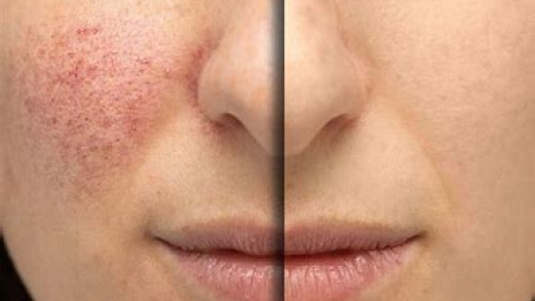 Rosacea Treatment Market Analysis Report and Opportunities Upto 2028