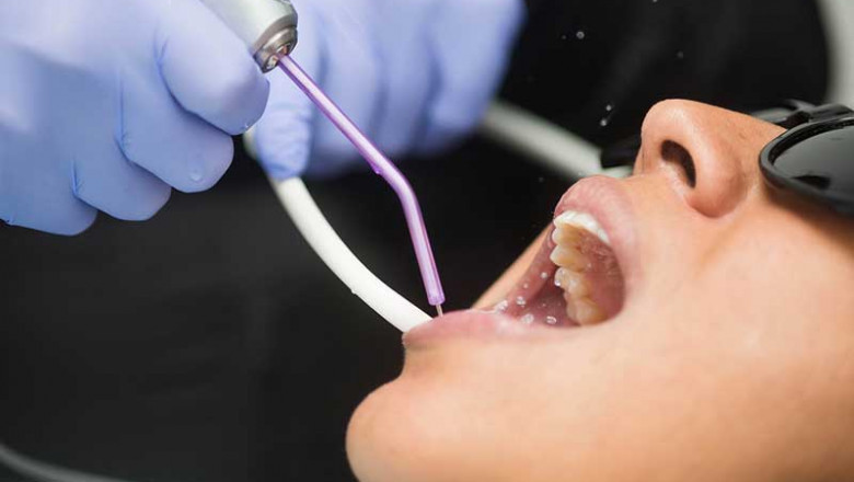 What Is A Composite Dental Filling?
