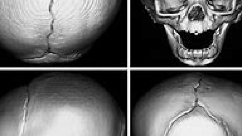 Achondroplasia Therapeutics Market Competitive Landscape and its Industry Growth Prospect By 2028