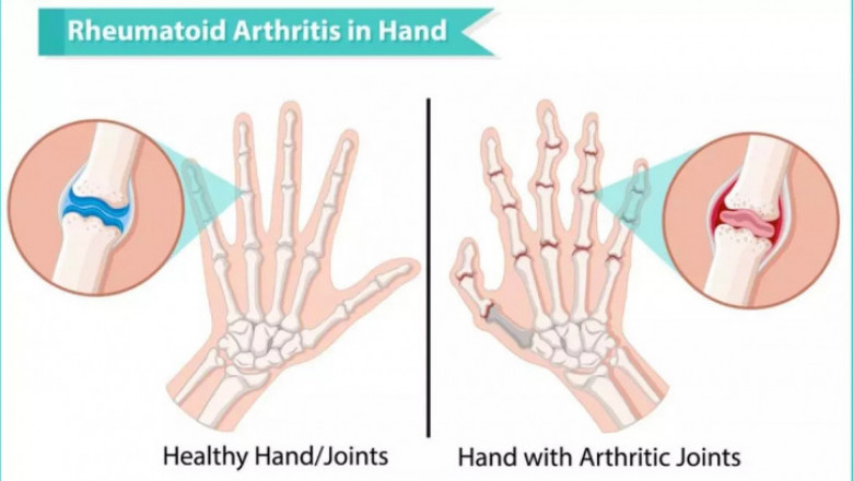Rheumatoid Arthritis in Hindi