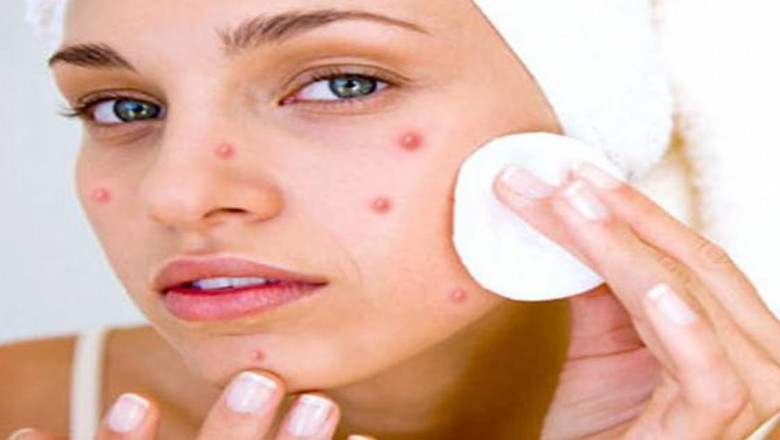 Acne and Pimples Treatment - Herbal Medicine For Blood Clean?