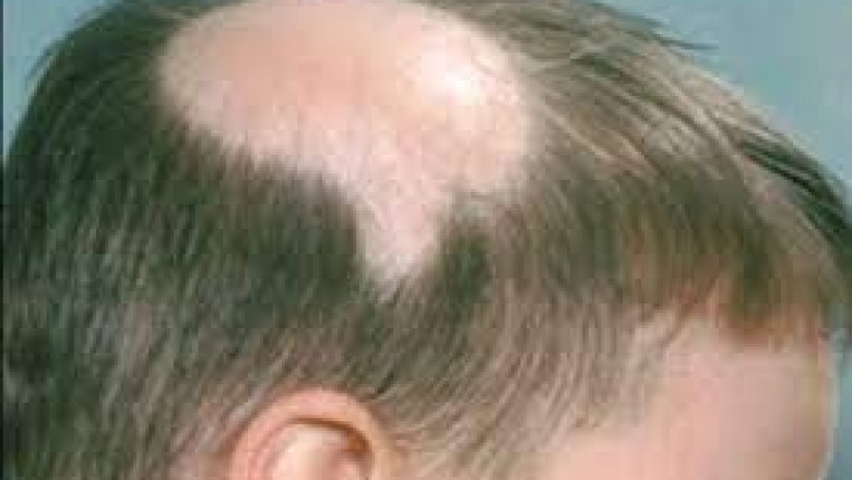 Global Alopecia Treatment Market 2022 - Top Key Players Analysis Report Till 2028