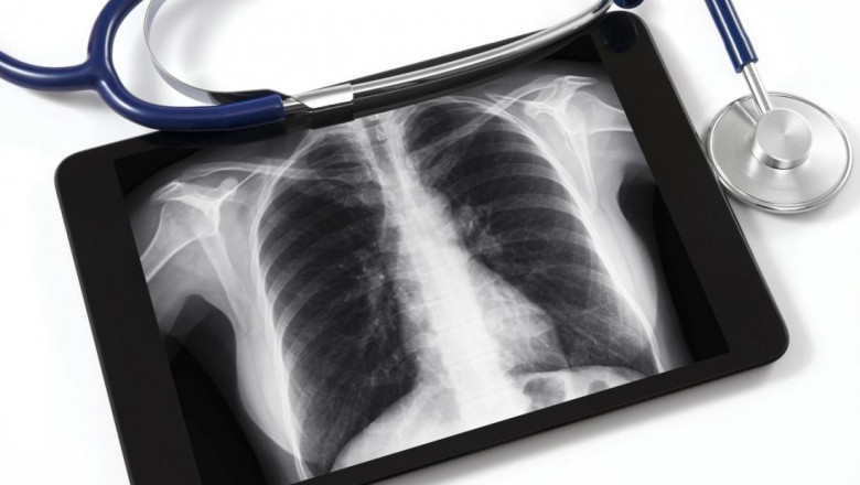 Pneumoconiosis Market Size, Share, Trends | Forecast 2029