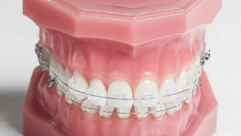Colorless Wires Are Nearly Visible in Invisalign