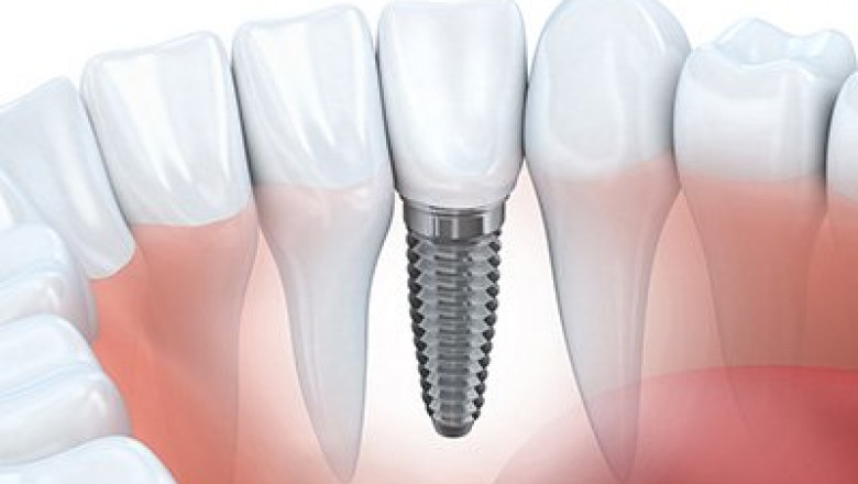 Dental Implants California