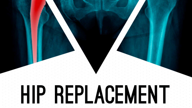Dr Anoop Jhurani Best Hip Replacement Doctor in Jaipur, India