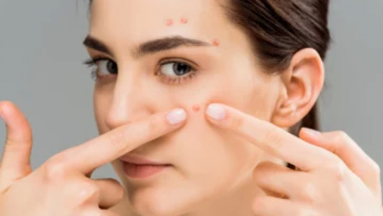 Acne Treatment in Pune
