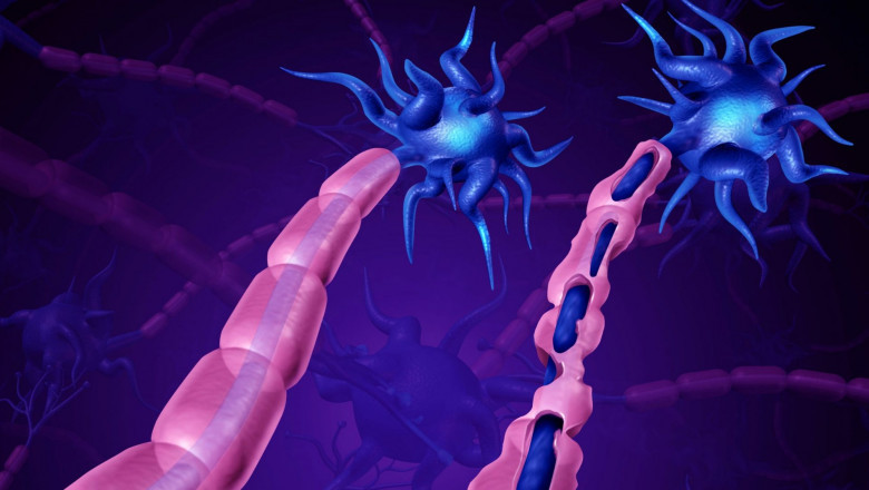 Chronic Inflammatory Demyelinating Polyneuropathy (CIDP) Treatment Aims To Stop The Immune Attack And Stabilize The Disease
