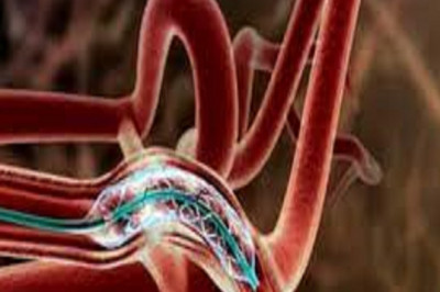 Intracranial Stents Market 2022 Major Key Players and Industry Analysis Till 2028