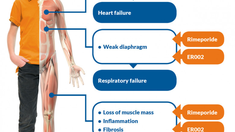 Muscular Dystrophy Treatment Can Slow Its Progression And Improve A Person's Mobility