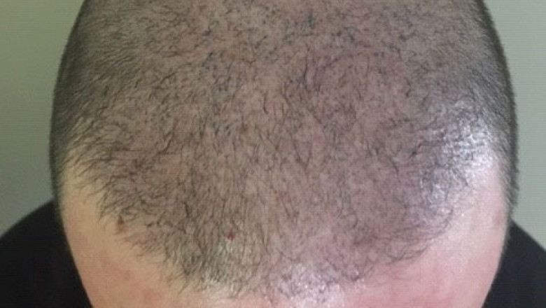 Restore Your Lost Self-Esteem with Scalp Micropigmentation