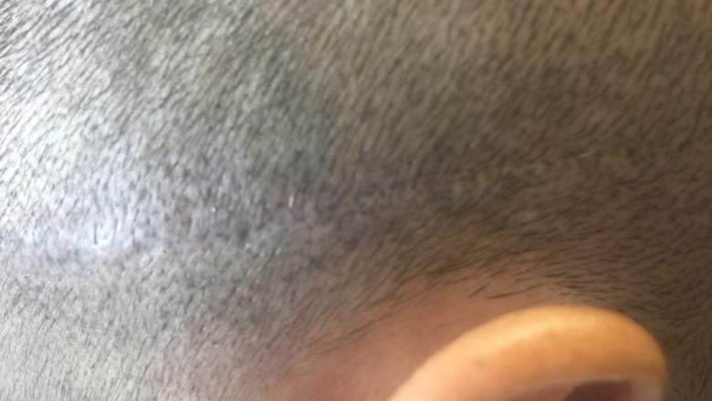 Three Main Reasons Behind Hair Loss Problems Faced by Everyone