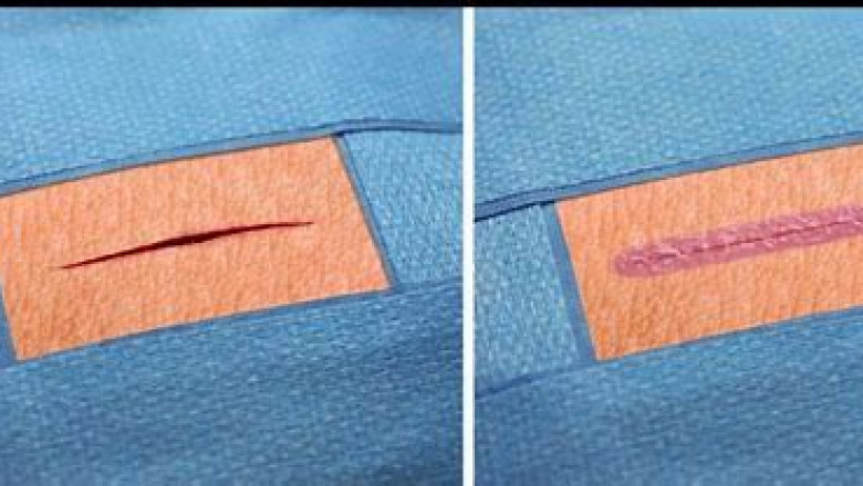 Topical Skin Adhesive Market Insight | Outlook | Growth Analysis Report 2022-2028