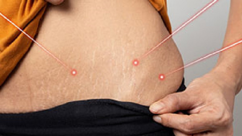 Laser Stretch Mark Removal Raleigh Nc | Raleighajcmedical.com
