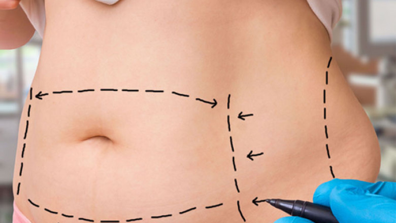 Liposuction in Delhi India Cost of Liposuction Surgery Delhi