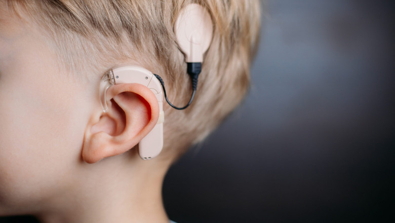 Cochlear Implant Surgery Is Fairly Common and Is Usually Done Under General Anesthesia