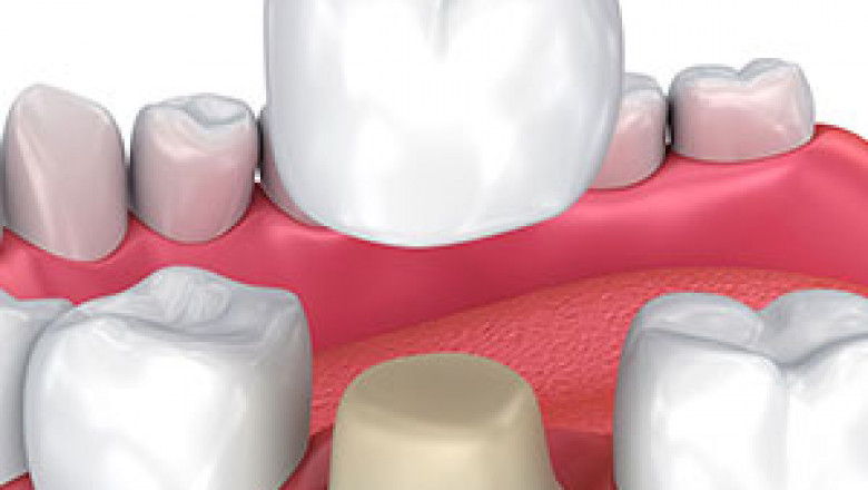 Dental Aesthetics - Everything about Dental Treatments