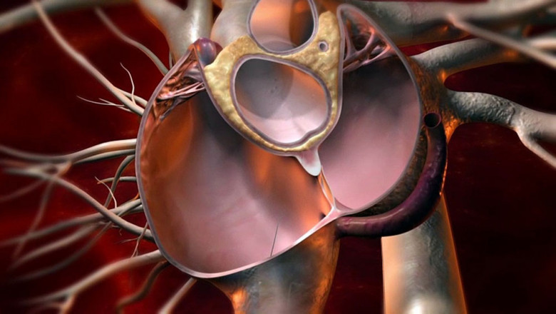 Global Patent Foramen Ovale (PFO) Closure Devices Market Restraints