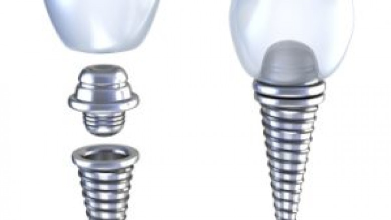 tooth replacement Houston